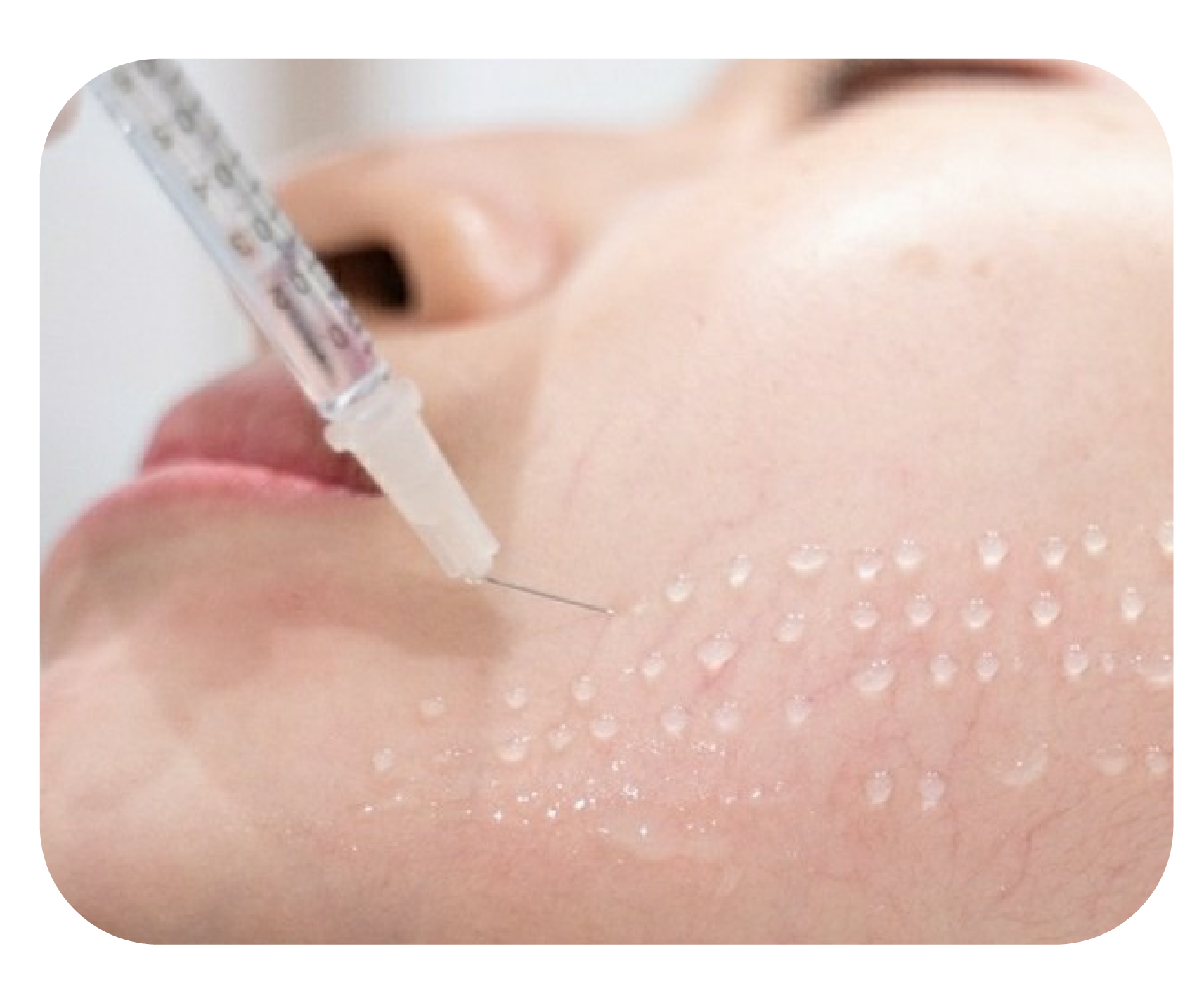 Mesotherapy